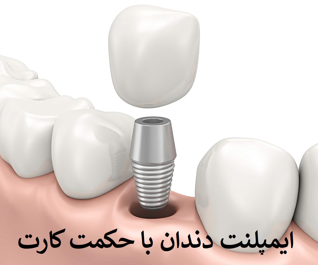 ایمپلنت دندان با حکمت کارت در تهران