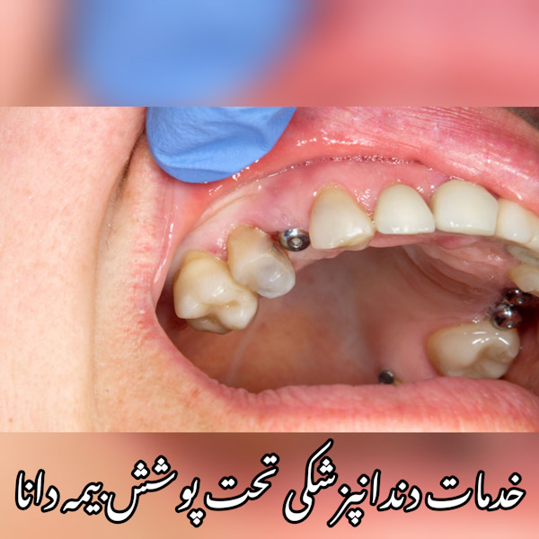 خدمات ایمپلنت دندان با بیمه دانا