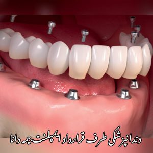 هزینه ایمپلنت دندان با بیمه دانا