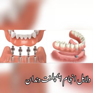 دلایل انجام ایمپلنت دندان با بیمه دانا