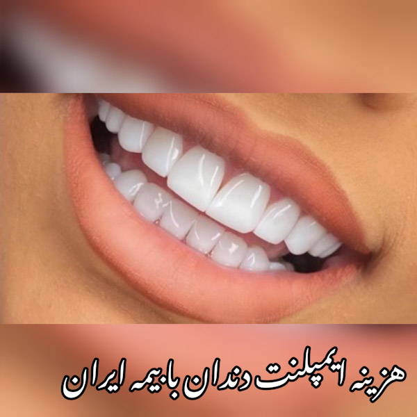 هزينه ایمپلنت دندان با بیمه ایران