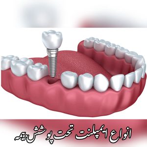انواع هزينه ایمپلنت دندان با بیمه ایران 