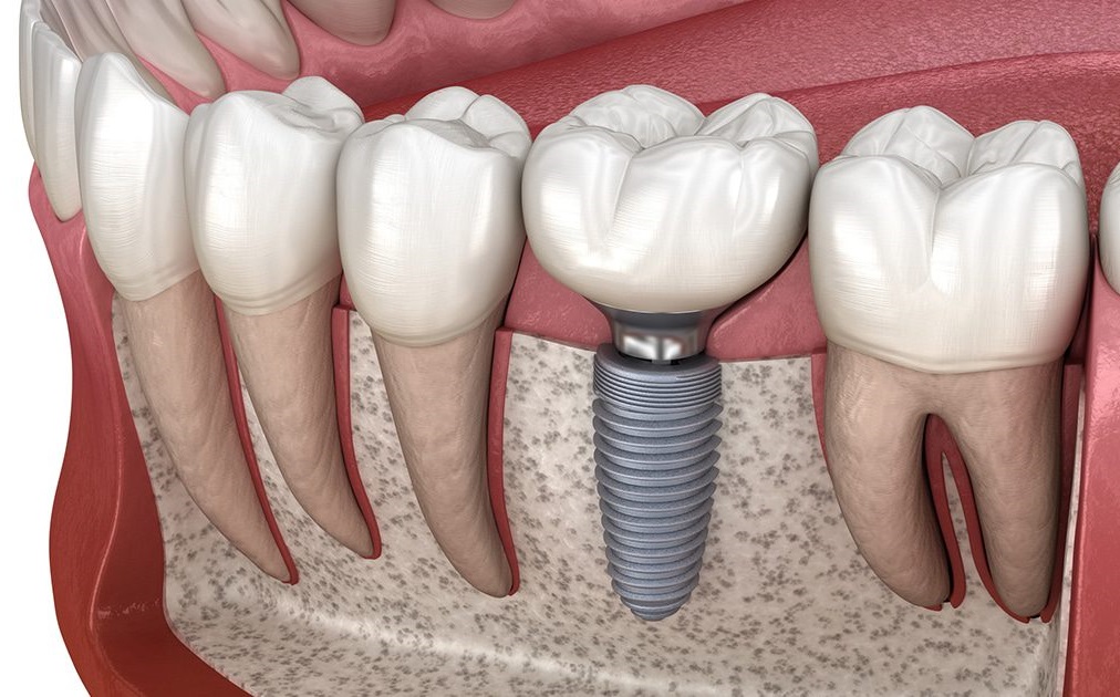 دوره آموزش ایمپلنت دندان در تهران دنتال بست