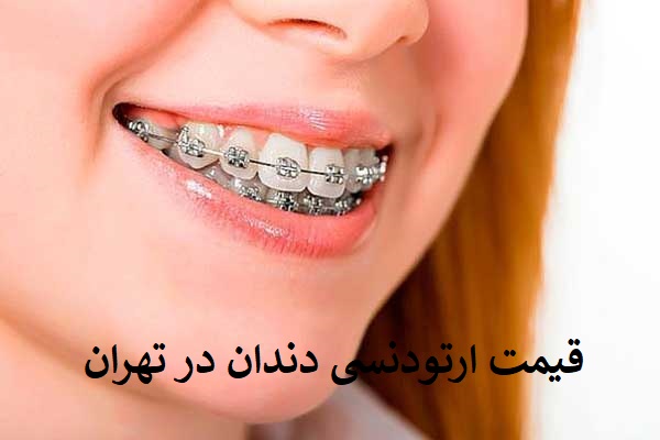 قیمت ارتودنسی دندان در تهران سال 1402