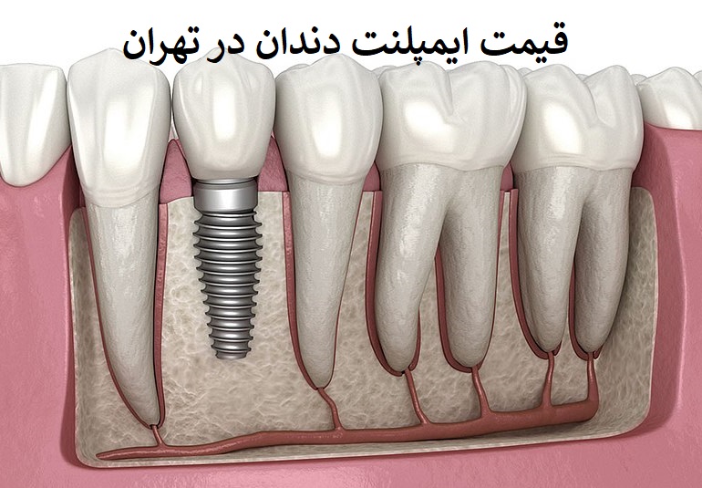 قیمت ایمپلنت دندان در دانشکده دندانپزشکی تهران 1402