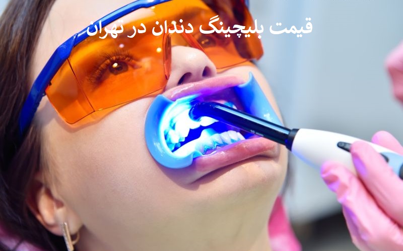 قیمت بلیچینگ دندان در تهران