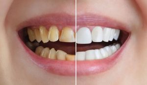 سفید شدن دندان های زرد در یک روز